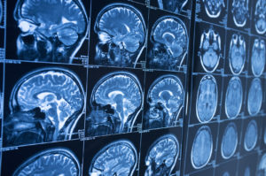 How Shaked Law Personal Injury Lawyers Can Help You After Suffering a Brain Injury in Miami
