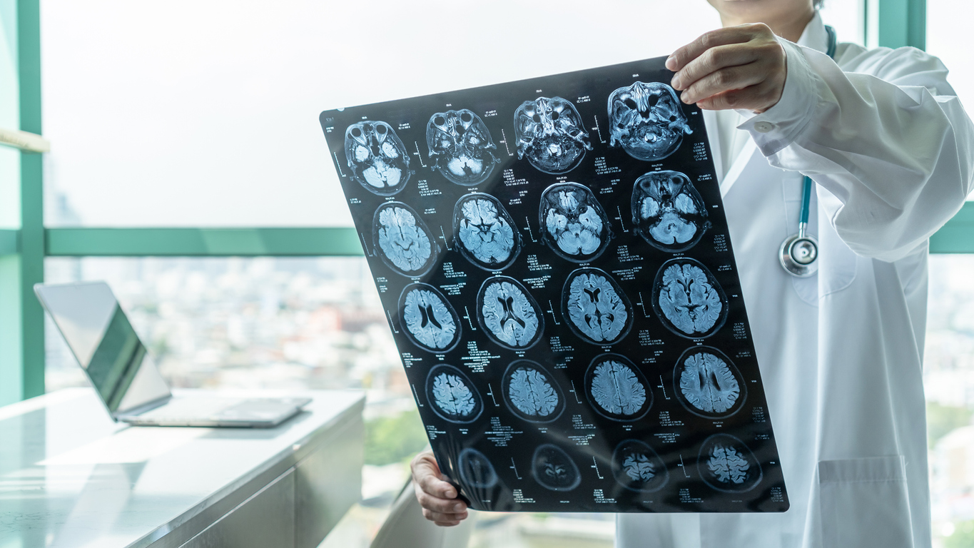 What Is Hemiplegia?